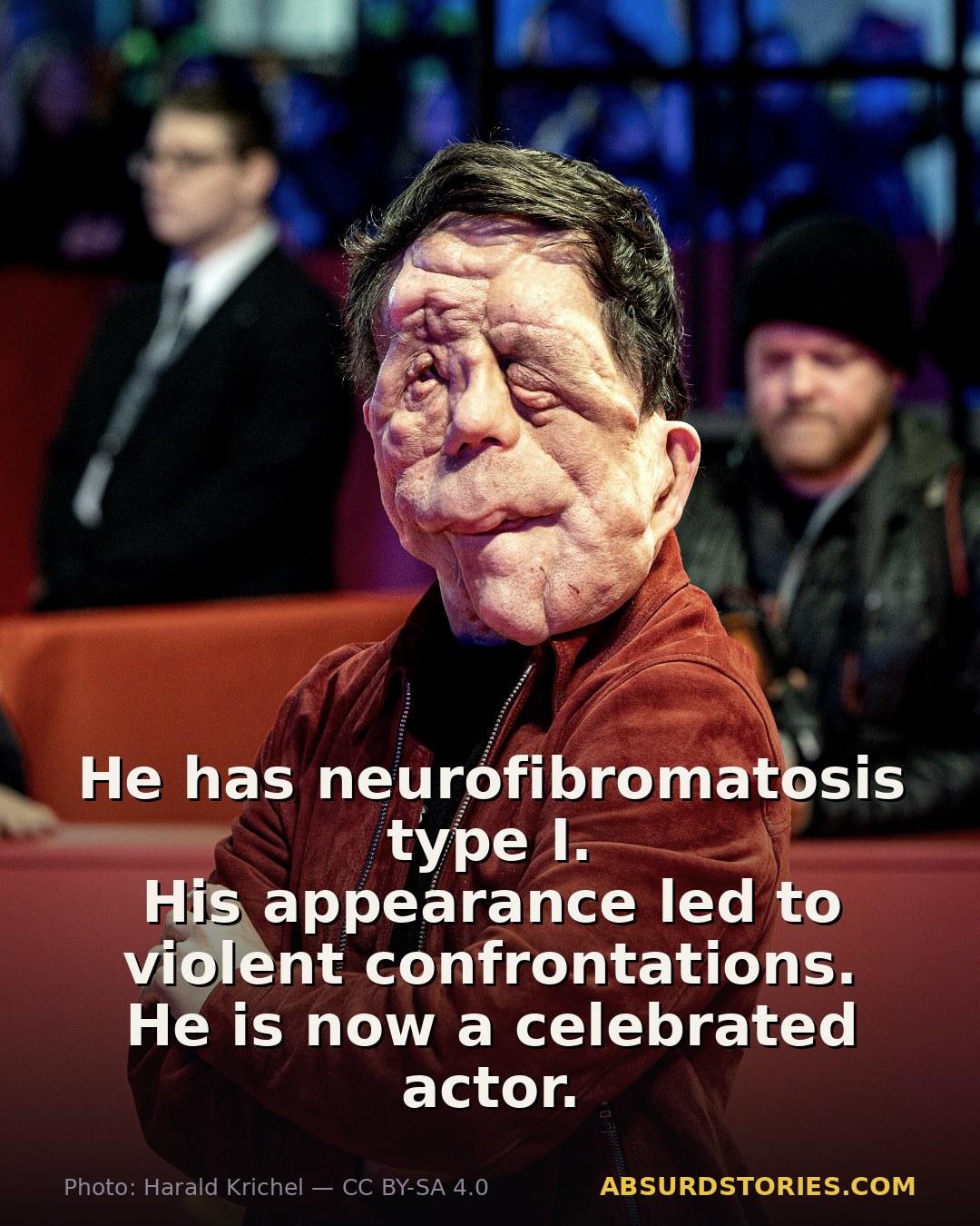 From bullying to acclaim: Adam Pearson's journey